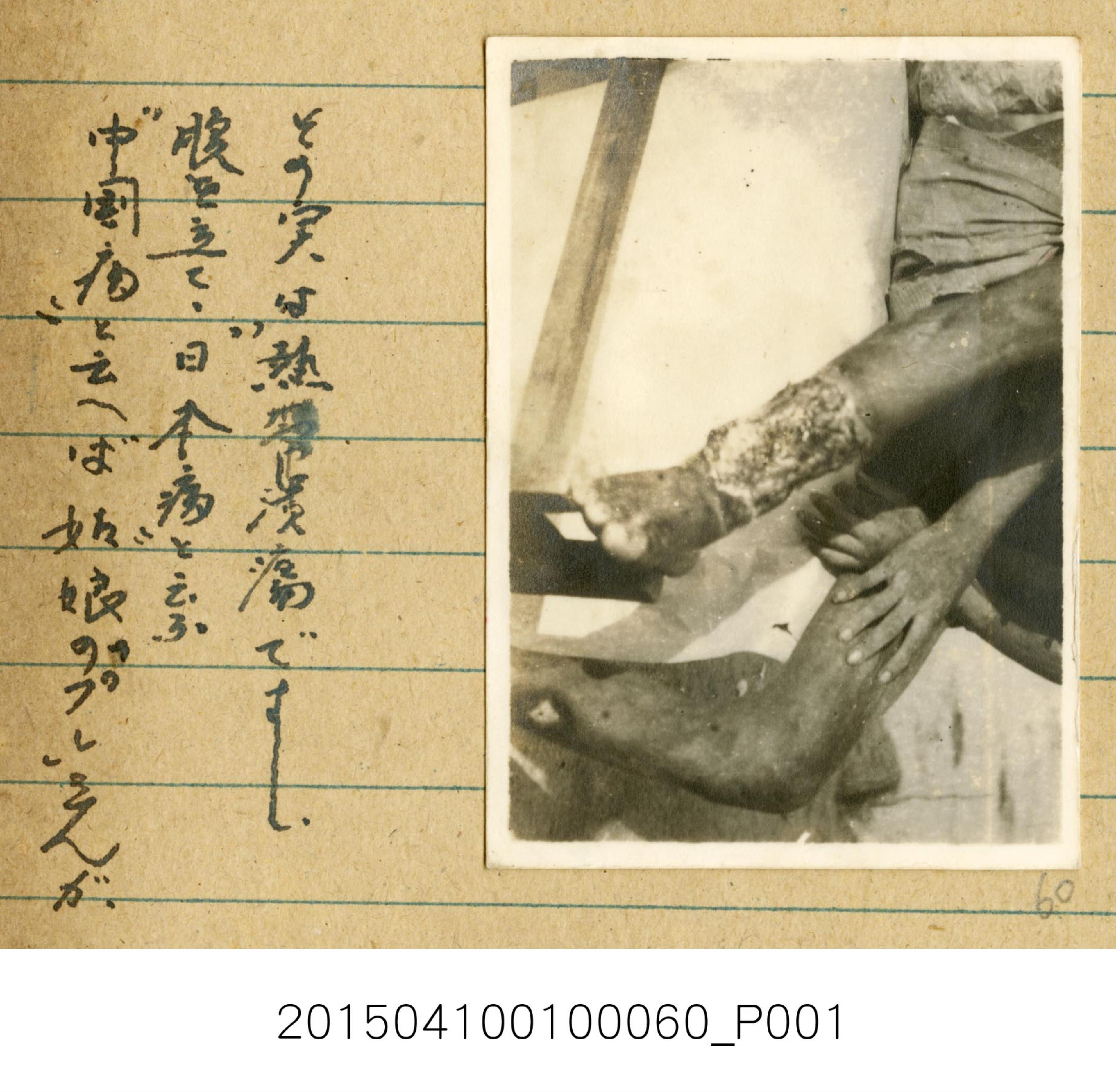 海南島期間熱帶潰瘍紀錄相片 (共1張)